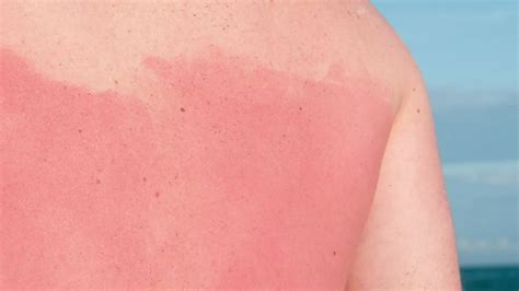 Consumer Health: What is a sunburn?